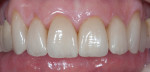 Figure 8 and Figure 9 Layered IPS e.max crowns for teeth Nos. 6 to 12. Clinical photography by Dr. H. Mizuta.