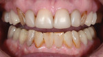 Figure 11 and Figure 12 This patient’s cuspids and laterals required an MO ingot, as the stump color was dark. Clinical photography by Dr. J.T. Green.