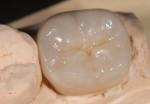Figure 4 A monolithic posterior restoration with minimal characterization enhances the anatomy and retains the overall value of the restoration.