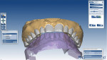 Figure 3 The Ceramill Map400 scans showing articulation of upper and lower arches.