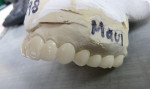 Figure 11 All temporary restorations, anterior veneers, and posterior crowns were placed on the model for patient presentation.