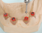Figure 1 The model has four implants in the anterior. The technician used the OT
EQUATOR “Seeger System” to create a passive connection among the implants.
This technique does not exclude the chance to use the threaded attachments.