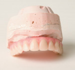 Figure 3 Denture wax-up, used as reference to provide maximum support while designing the bar.