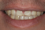 Figure 2 Close-up smile was guarded before treatment.