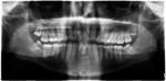 Figure 3 Panoramic radiograph before treatment.