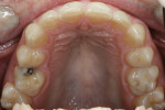 Figure 5 Upper arch before treatment.