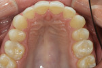 Figure 13 Upper arch after treatment.
