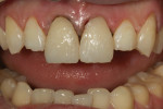 Figure 9 Central incisors built up to full contour.