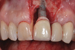 Figure 10. Appearance following removal of cement and granulomatous tissue.