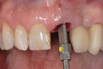 Figure 3 Line on implant driver indicating that implant shoulder is located at its proper vertical position approximately 2.5 mm apical to facial gingival margin.