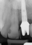 Figure 6 Radiograph after 4 months; provisional restoration is observed.