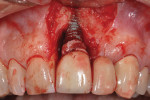 Figure 9 Full-thickness flap demonstrating bone loss and appearance of excess cement on implant abutment and implant fixture.