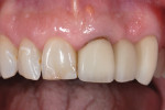 Figure 1 Initial presentation, three-unit fixed partial denture (FPD), Nos. 9 through 11.