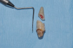 Figure 2 Tooth No. 9 following sectioning of FPD and extraction; oblique root fracture is evident.