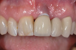 Figure 13 6-week follow-up; tissue loss is apparent compared to previous images. The exposure of the zirconia abutment and the tissue loss has resulted in a poor esthetic outcome.