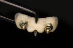 Figure 1 This cemented implant bridge had extremely poor fitting margins and loose screws, leading to irresolvable peri-implantitis, and had to be removed.