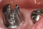 Figure 9 Round bur was carefully used to cut slot in opposite sides of the screw head. Slots cut into abutment are not necessary, but make visualization easier. Note healing abutment in place on adjacent implant to prevent contamination from titanium shards.
