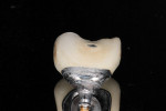 Figure 3 Lingual porcelain on this cemented implant porcelain-fused-to-metal (PFM) has fractured off. Note lack of metal framework support.