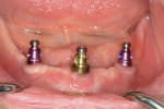 Figure 1 Impression copings connected to the two posterior narrow diameter (3.5 mm) and central 4.3-mm diameter implants.