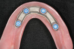 Figure 9 Locator metal housings and attachments processed into the denture base.