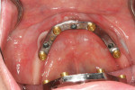 Figure 7 Intraoral bar try-in confirmed a passive connection to the three implants.