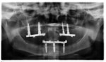 Figure 13 Panoramic radiograph of the CAD/CAM produced maxillary and mandibular titanium bars.