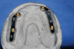 Figure 10 Two CAD/CAM milled titanium bars provided unilateral splinting of the maxillary implants.
