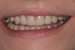 Figure 8 Post-restorative 1:3 full smile.