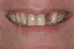 Figure 12 The preoperative 1:3 full smile. Note the dominance of the central incisors.
