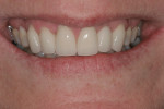 Figure 16 The postoperative 1:3 full smile. The central incisors were shortened by 1.2 mm and the horizontal edge was moved more towards the lingual. The incisors are less dominant in the smile.