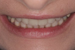 Figure 11 Post-restorative tip down smile photo.