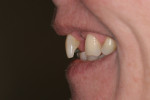 Figure 15 The 90-degree photo demonstrates excessive tooth contour to the facial.