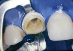 Figure 1 Overpreparation needlessly removed large amounts of dentin, leading to a structural weakening of the tooth.