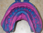 Figure 2 A highly accurate full-arch clear aligner impression using Imprint 4 VPS Impression Material.