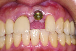 Figure 1 Incorrect vertical and buccal-palatal implant placement.