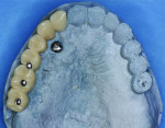 Figure 10 Provisional restoration with an ideal tooth setup reveals the incorrect buccal-palatal implant placement.