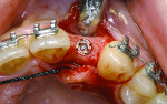 Figure 12 Implant placement replacing congenitally missing lateral incisors.
