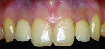 Figure 14 Improved result with customized zirconia abutments and zirconia crowns.