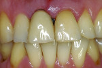 Figure 15 Clinical situation 1 week after implant placement.