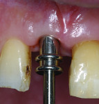Figure 16 Clinical situation after 5 weeks. Both interdental papillae have been lost.