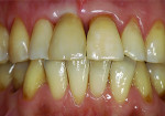 Figure 17 Clinical situation after 6 weeks. The final restoration has been placed.