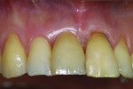 Figure 19 Clinical situation one year after insertion, demonstrating soft-tissue regeneration due to the stable cortical bone and the healthy adjacent teeth.