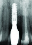 Figure 18 Radiographic situation after 1 year. Note there was no peri-implant bone loss.