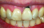 Figure 1 Dentofacial presentation showing the midfacial soft tissue recession defect of the metal implant abutment within the patient’s smile. The patient was extremely unhappy and embarrassed about her esthetic condition.