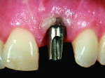 Figure 3 The recession defect is due to an incorrectly contoured custom abutment secondary to a poorly placed implant with excessive facial angulation