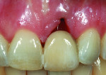 Figure 5 The soft tissues will subsequently heal over the healthy implant allowing primary closure of the flap if subsequent augmentation is required. A resin-bonded retained provisional bridge is used as a transitional fixed restoration. A fixed provisional is more advantageous if subsequent surgery is required.