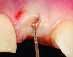 Figure 8 Three-months post-healing reveals 5 mm vertical soft tissue growth over the implant cover screw after sounding with a periodontal probe. An additional augmentation procedure was not required in this clinical situation.