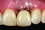 Figure 10 The patient’s pre-existing ceramometal crown was relined with acrylic resin and used as a temporary restoration.