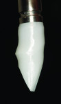 Figure 12 An all-ceramic CAD/CAM abutment was made respecting the flat subgingival contours needed to keep the FGM margin stable in its new coronal position. Zirconia ceramics was selected for tissue color, compatibility, and strength.