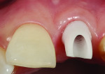 Figure 13 Intraoral view of the inserted flat-profiled abutment showing the passive interface with the soft tissues.